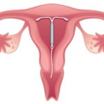 Mulheres interessadas em colocar DIU devem ir ao Hmib na segunda-feira (17)