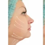 O que são os fios de PDO e por que fazem tão bem à pele?