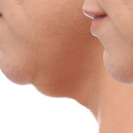 Afinal, dentista pode fazer Lipo de Papada?