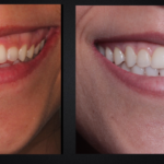 Você já ouviu falar em gengivoplastia?